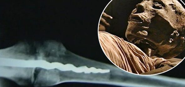 Prosthetic Pin Discovered In Ancient Egyptian Mummy